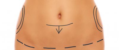 Bodylift