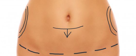 Bodylift