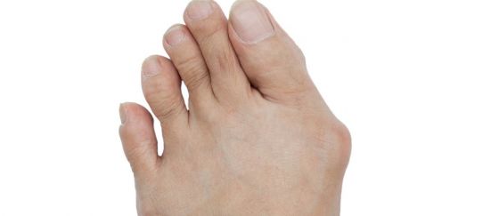 Hallux valgus, operasjon